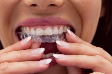 Best InvisAlign Treatment in Ahmedabad.png