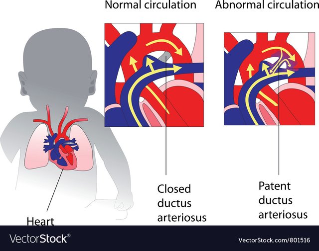 A Heart Warrior of Patent Ductus Arteriosus (PDA) — Steemit