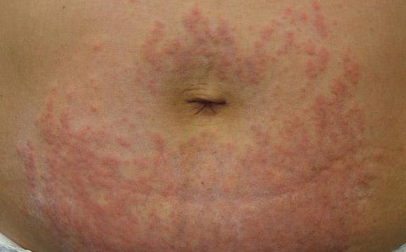 maculopapular rash. Pruritic urticarial papules and plaques of pregnancy.