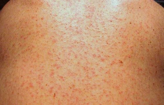 Measles macupapular rash.
