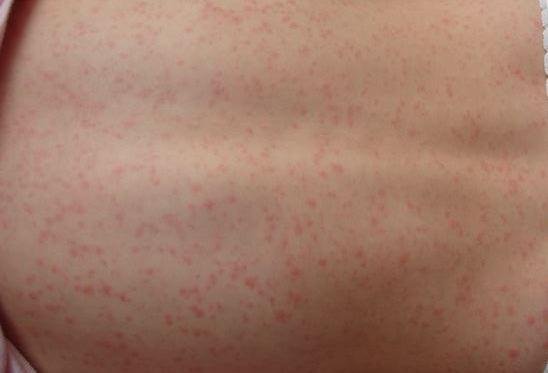 Scarlet fever maculopapular rash. Image credit: Estraya, (2007, February 9).