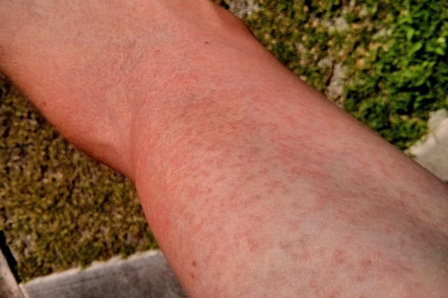 Zika virus Macupapular rash. Image credit: FRED, (2014, January 10).