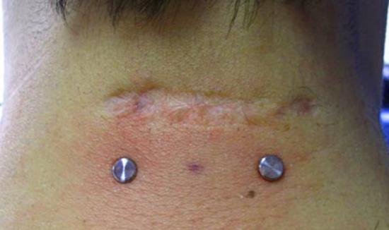 Piercing rejection scar on nape piercing.