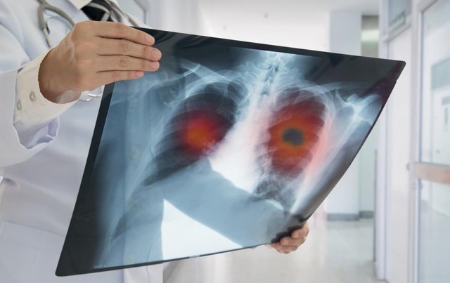 Doctor looking at lung X-ray