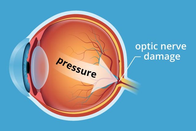 Glaucoma