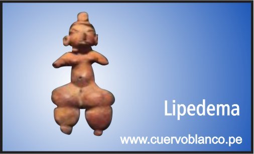 lipedema