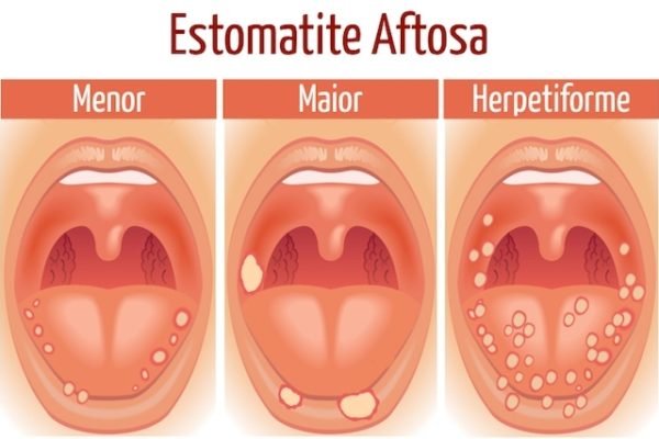 Do You Want To Know What Are The Causes Of Stomatitis And How Can We Treat It Here We Explain Steemit