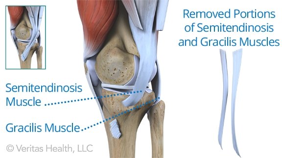 what do athlete fear the most anterior cruciate ligament acl
