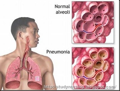 pneumoniavirusproteinmodeldiscovered_5965_thumb7.jpg