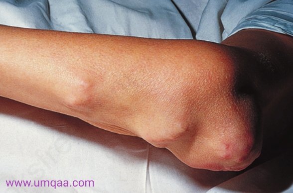 Rheumatoid nodules .jpg