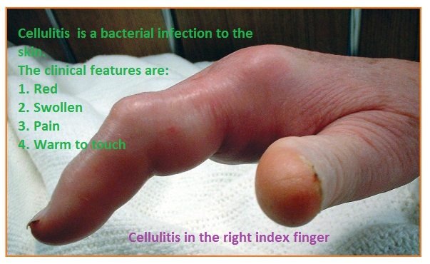 cellulitis.jpg