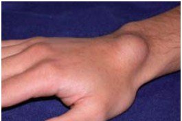 ganglion.jpg