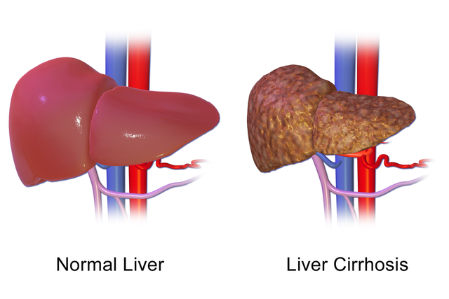 Liver_Cirrhosis.png