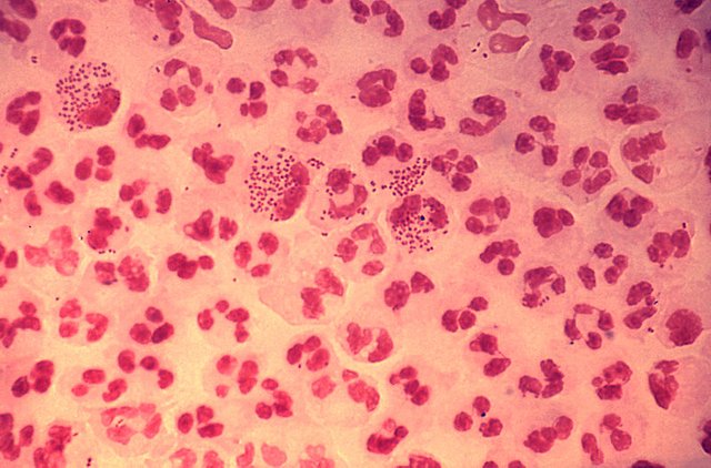 Gonococcal_urethritis_PHIL_4085_lores.jpg