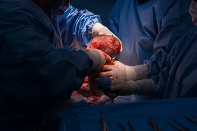 크기변환_400pixelcesarean section.jpg