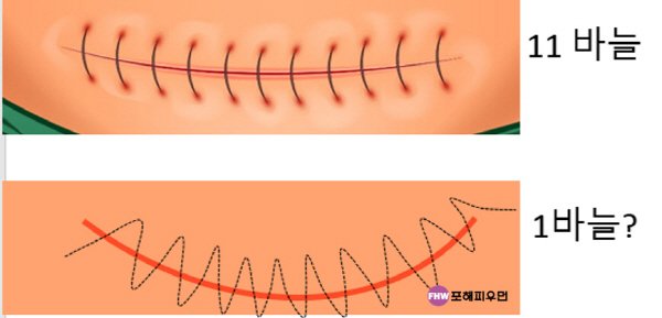 임신준비-제왕절개-american suture