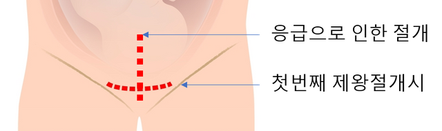 임신준비-제왕절개-흉터-십자.png