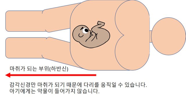 임신준비-무통분만-그림4.jpg