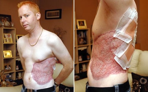 Human Flesh Eating Bacteria Steemit