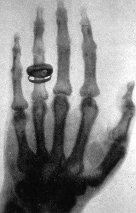 X-ray_by_Wilhelm_Röntgen_of_Albert_von_Kölliker's_hand_-_18960123-02.jpeg
