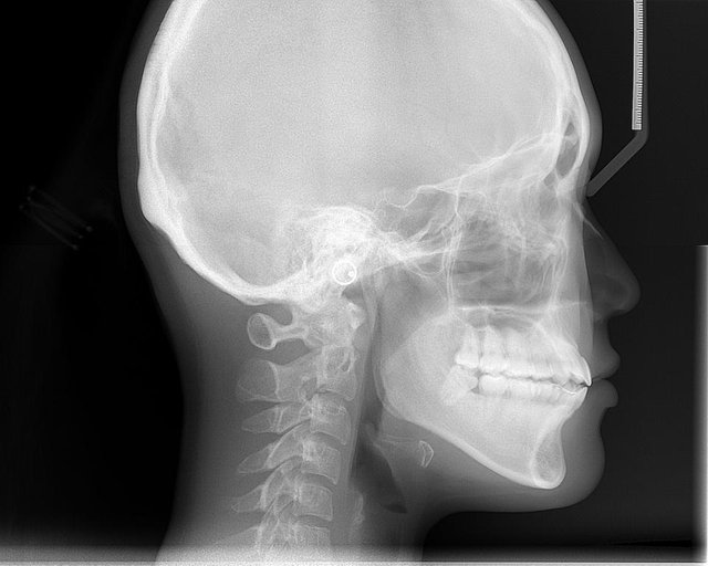 Cephalometric_radiograph.jpeg