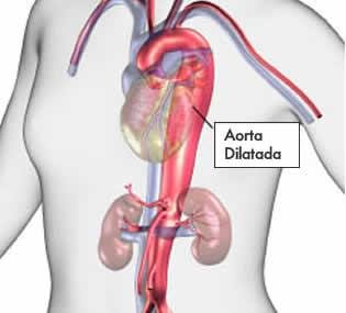 sindrome-marfan (1).jpg