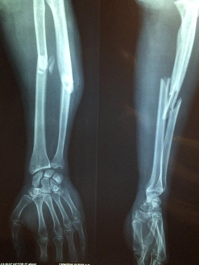 fracture-bone-2333164_1280.jpg