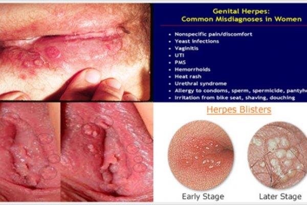 13622861141_new-medical-treatments-for-genital-herpes.jpg