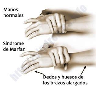 marfan.jpg