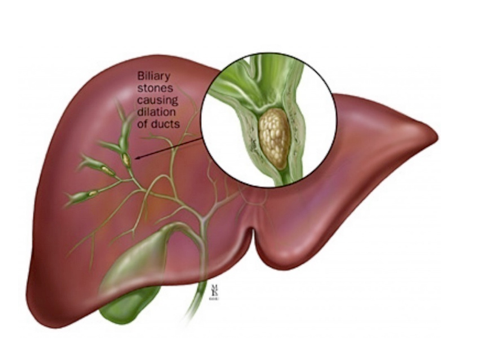 liver-stones.png