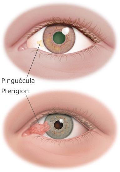 pterigion-pinguecula.jpg