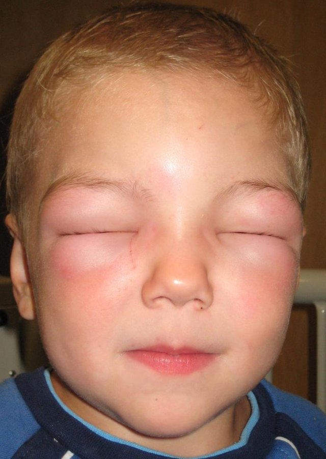 Angioedema2010.jpeg