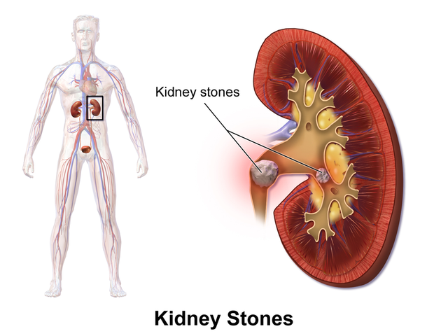 KidneyStones.png