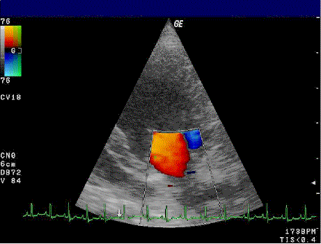 Doppler_mitral_valve.gif