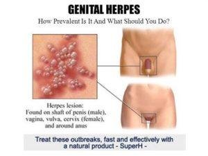 genital-herpes-300x225.jpg