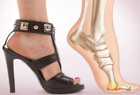 webmd_rf_photo_of_foot_pain_from_heels.jpg