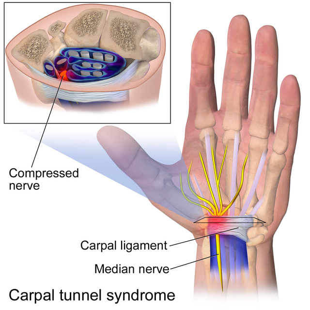 Carpal_Tunnel_Syndrome.png