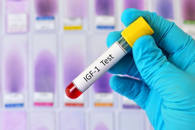 Lab technician holding IGF-1 blood sample test tube