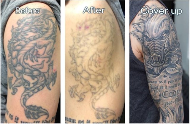 Ctrl Alt Del Tattoo Lightening  Removals  When clients share their  progress Our focus is to not only remove tattoos but to ensure that we  preserve the integrity of your skinAfter