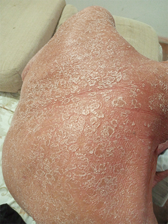 Psoriasis-abuelo-1.png