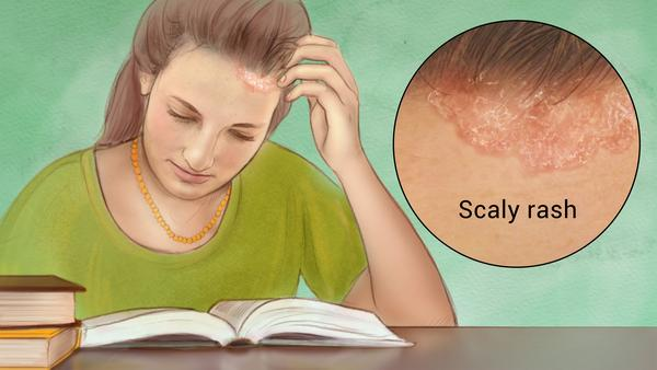 cara menghilangkan penyakit psoriasis