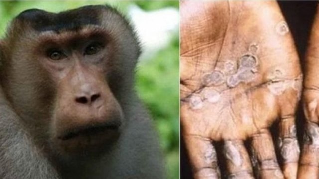 First cases of monkeypox in US children reported