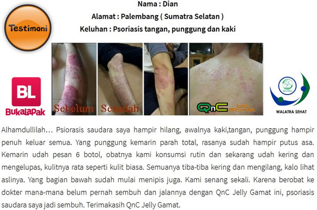 Cara Menghilangkan Penyakit Psoriasis