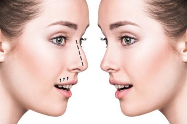 rhinoplasty surgery