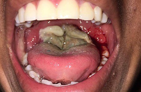 Resultado de imagen para garganta infectada por difteria