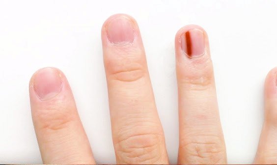 Red Lines Under Nails : Associated symptoms and signs include ...