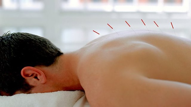 a man receiving accupuncture for erectile dysfunction