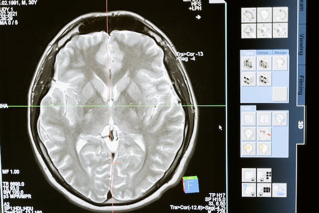 Brain MRI