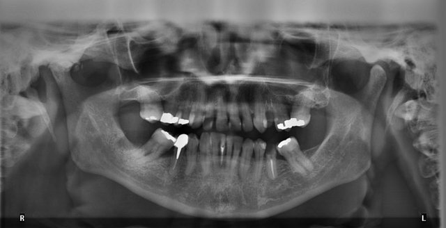 teeth xray.JPG