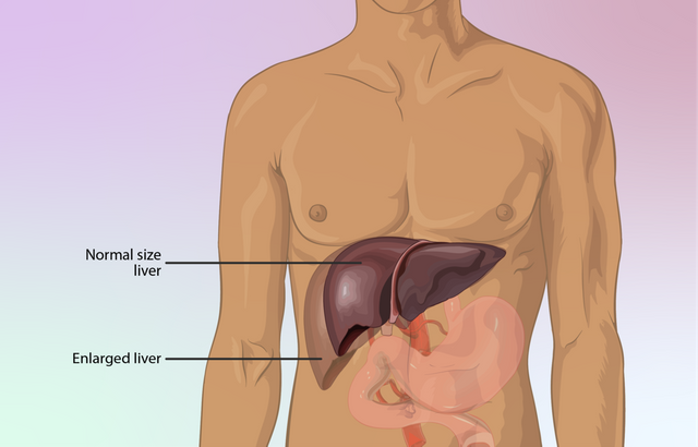 1200px-Depiction_of_an_enlarged_liver.png